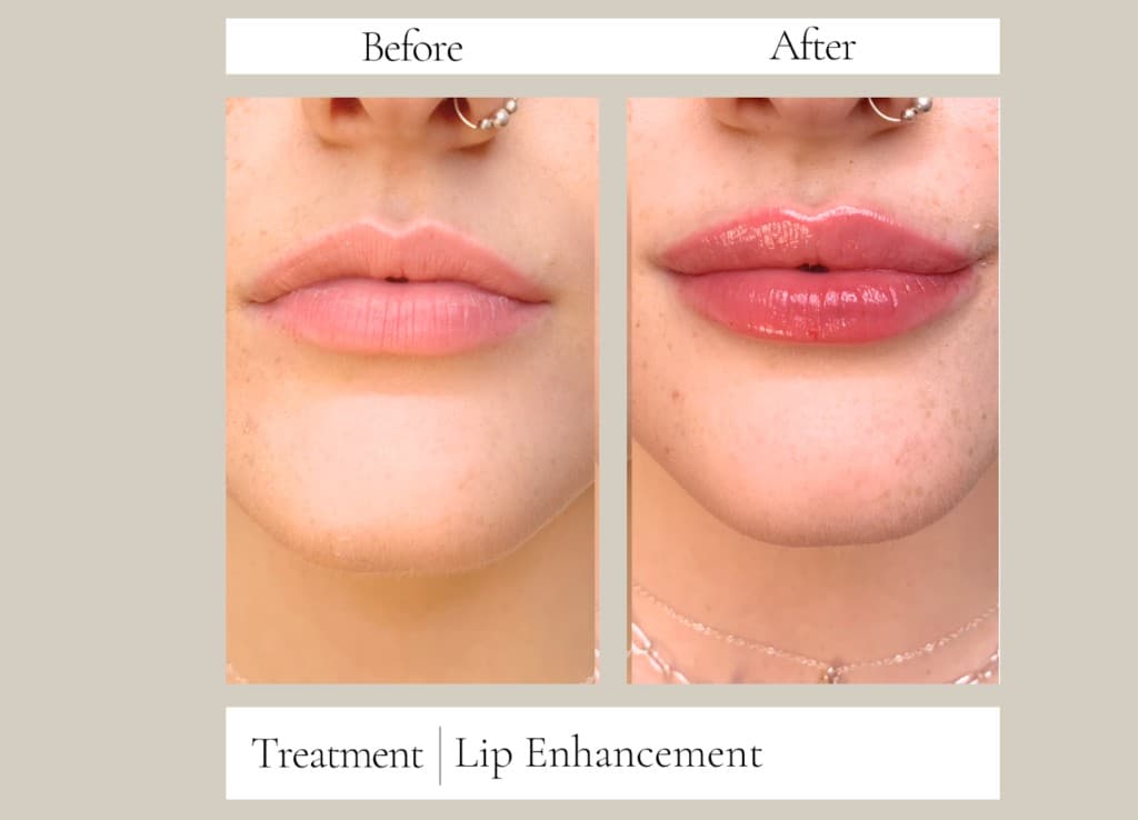 Before and after lip enhancement