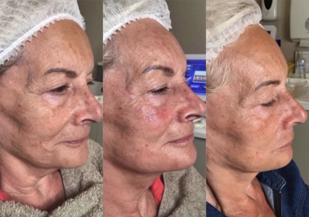 Side profile of a patient before treatment, immediately after, and 12 weeks later
